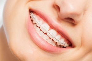 Les traitements orthodontiques pour adulte à Rosny sous bois
